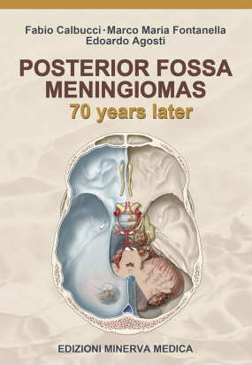 Posterior fossa meningiomas