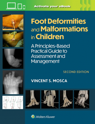 Foot Deformities and Malformations in Children, Second Edition