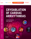 Cryoablation of Cardiac Arrhythmias