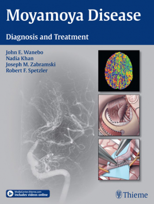 Moyamoya Disease  Diagnosis and Treatment 