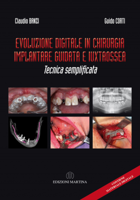 Evoluzione Digitale in Chirurgia Implantare Guidata e Iuxtaossea