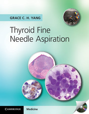 Thyroid Fine Needle Aspiration with CD Extra