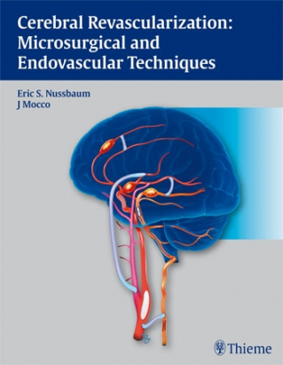 Cerebral Revascularization: Microsurgical and Endovascular Techniques