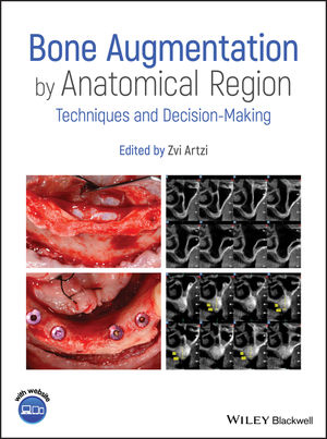 Bone Augmentation by Anatomical Region: Techniques and Decision-Making