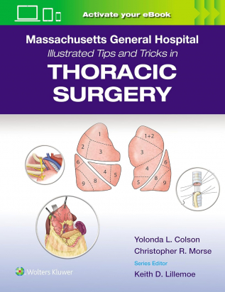 Massachusetts General Hospital Illustrated Tips and Tricks in Thoracic Surgery