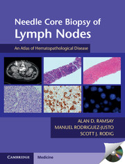 Needle Core Biopsy of Lymph Nodes with DVD-ROM